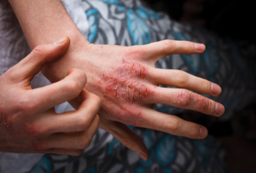 Moderate to Severe Atopic Dermatitis