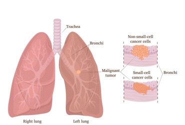 FDA Approves Imfinzi And Imjudo Combo For Metastatic NSCLC